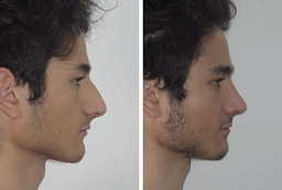 رأب الحاجز الأنفي وتخفيض التوربينات 8 رأب الحاجز الأنفي وتصغير التوربينات قبل بعد