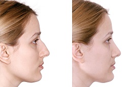 رأب الحاجز الأنفي وتصغير التوربينات قبل وبعد