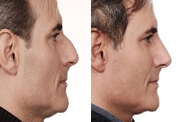 قبل وبعد رأب الحاجز الأنفي وتصغير التوربينات