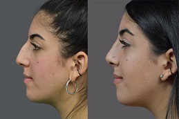 تجميل الانف في أبو ظبي 8 تجميل الانف في أبو ظبي قبل بعد