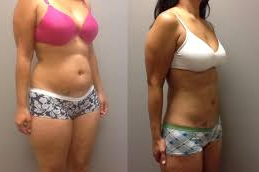 جراحة شفط الدهون في أبو ظبي 5 شفط الدهون في أبو ظبي قبل بعد