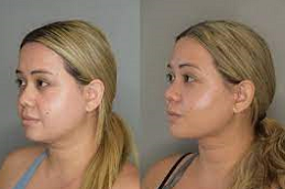 شفط دهون الذقن المزدوج في أبو ظبي قبل بعد