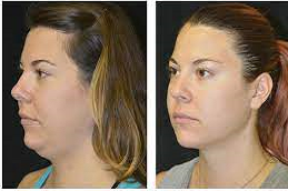 قبل وبعد شفط دهون الذقن المزدوج في أبو ظبي