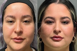 إزالة دهون الشدق في أبو ظبي 8 إزالة دهون الشدق في أبو ظبي قبل بعد