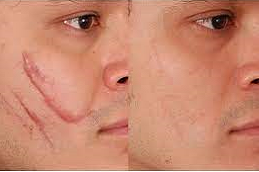 تصحيح الندبات الجراحية 8 تصحيح الندبات الجراحية في أبوظبي قبل بعد