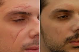 تصحيح الندبات الجراحية في أبوظبي قبل وبعد