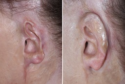 جراحة ترميم الحروق في أبو ظبي 8 جراحة ترميم الحروق في أبو ظبي قبل بعد