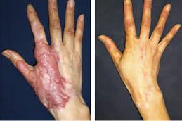 جراحة ترميم الحروق في أبو ظبي 7 جراحة ترميم الحروق في أبو ظبي قبل وبعد