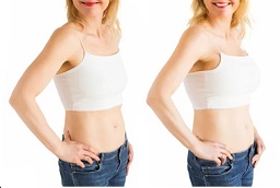 جراحة رفع الثدي في أبوظبي 8 جراحة رفع الثدي في أبوظبي قبل بعد