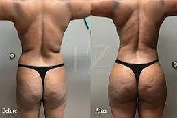 جراحة نقل الدهون في أبو ظبي قبل بعد