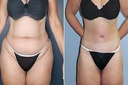 جراحة نقل الدهون في أبو ظبي قبل وبعد