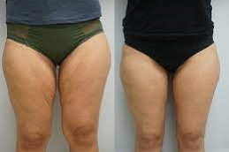 عملية شد الفخذين 8 عملية شد الفخذ في أبو ظبي قبل بعد