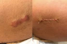 قبل وبعد تصحيح الندبات الجراحية في أبوظبي