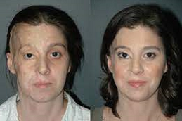 جراحة ترميم الحروق في أبو ظبي 6 قبل وبعد جراحة ترميم الحروق في أبو ظبي