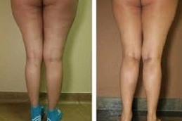 قبل وبعد جراحة نقل الدهون في أبو ظبي