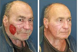 قبل وبعد علاج ندبات الوجه في أبوظبي