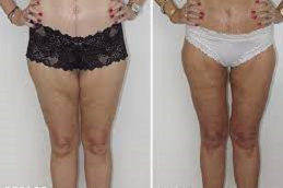 قبل وبعد عملية شد الفخذ في أبو ظبي