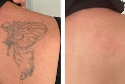 إزالة الوشم بالليزر في أبو ظبي قبل وبعد