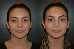 الفيلر تحت العين في أبو ظبي قبل وبعد