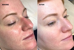 تقشير الكربون بالليزر 7 تقشير الكربون بالليزر في أبوظبي قبل وبعد