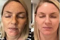 تقشير كوزميلان 8 تقشير كوزميلان في أبوظبي قبل بعد