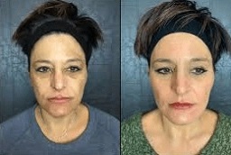 تقشير كوزميلان في أبوظبي قبل وبعد