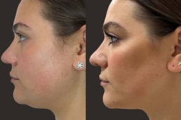 حقن إذابة الدهون 8 حقن إذابة الدهون في أبو ظبي قبل بعد