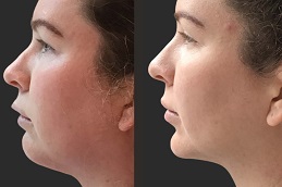 حقن إذابة الدهون 7 حقن إذابة الدهون في أبو ظبي قبل وبعد