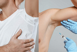 حقن البوتوكس للغدد المتعرقة 8 حقن البوتوكس للغدد المتعرقة قبل بعد