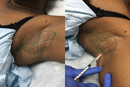 حقن البوتوكس للغدد المتعرقة قبل وبعد