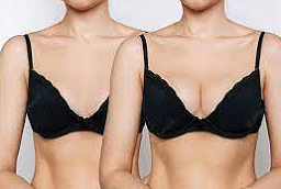 زراعة الثدي بالسيليكون 8 زراعة الثدي بالسيليكون في أبو ظبي قبل بعد