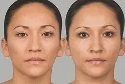 سكلبترا فيلر 8 سكلبترا فيلر في أبو ظبي قبل بعد