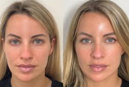 سكلبترا فيلر 7 سكلبترا فيلر في أبو ظبي قبل وبعد