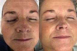 علاج الميزوثيرابي في أبو ظبي قبل بعد