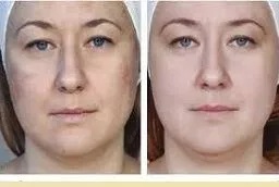 علاج الميزوثيرابي في أبو ظبي قبل وبعد