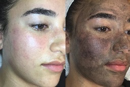 تقشير الكربون بالليزر 6 قبل وبعد تقشير الكربون بالليزر في أبوظبي