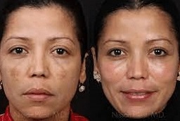 قبل وبعد تقشير كوزميلان في أبوظبي