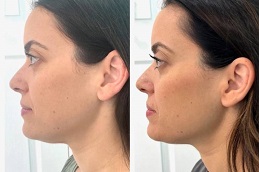 حقن إذابة الدهون 6 قبل وبعد حقن إذابة الدهون في أبو ظبي