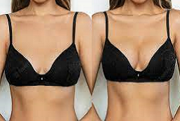 قبل وبعد زراعة الثدي بالسيليكون في أبو ظبي