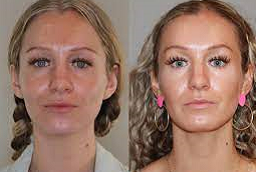 سكلبترا فيلر 6 قبل وبعد سكلبترا فيلر في أبو ظبي