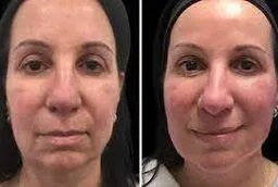 قبل وبعد علاج الميزوثيرابي في أبو ظبي