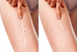 إزالة الندبات المتضخمة في أبو ظبي قبل بعد