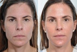 جراحة رفع الحاجب في أبو ظبي 8 جراحة رفع الحاجب في أبو ظبي قبل بعد