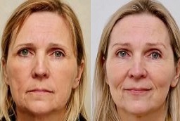 جراحة رفع الحاجب في أبو ظبي قبل وبعد