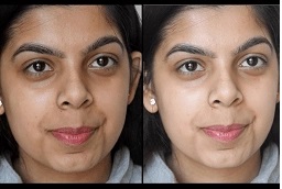 إزالة السمرة 8 علاج إزالة السمرة في أبوظبي قبل بعد