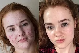 علاج إزالة السمرة في أبوظبي قبل وبعد