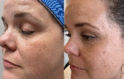 علاج الوخز بالابر الدقيقة 8 علاج الوخز بالابر الدقيقة في أبو ظبي قبل بعد