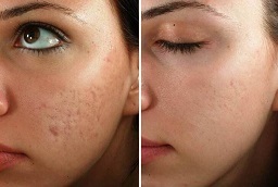 علاج الوخز بالابر الدقيقة في أبو ظبي قبل وبعد