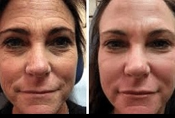 علاج ديرمابين 8 علاج ديرمابين في أبوظبي قبل بعد