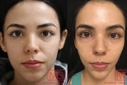 علاج ديرمابين 7 علاج ديرمابين في أبوظبي قبل وبعد